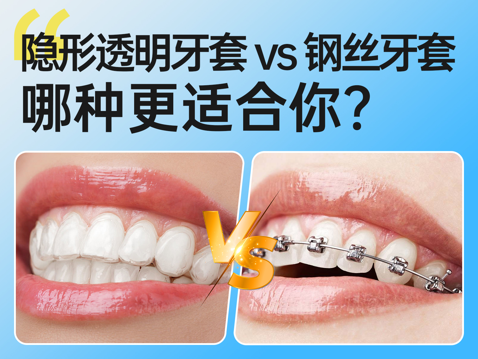 隐形透明牙套 vs. 钢丝牙套：哪种更适合你？