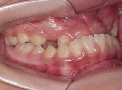 正雅S10适合哪些面型？地包天隐形矫正的理想选择