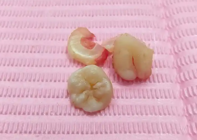 2025深圳拔牙费用详情：智齿、儿童和残根拔牙价格对比