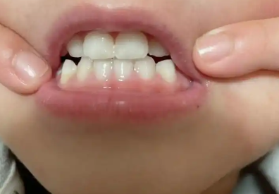 儿童地包天矫正多少钱？不同种类矫正器对比分析