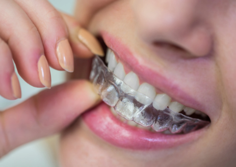 牙齿矫正要多少钱？正畸方案、拔牙、骨钉与牙套费用解析