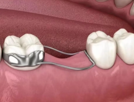 什么是牙齿间隙保持器？儿童牙齿间隙保持器价格及使用指南