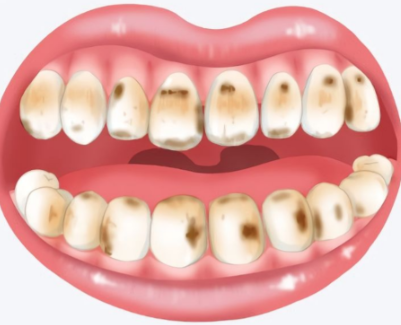 氟斑牙怎么去除？氟斑牙和四环素牙的美白方法解析