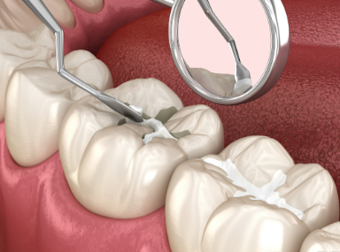 补牙用什么材料好？3种常见补牙材料的价格及优缺点解析