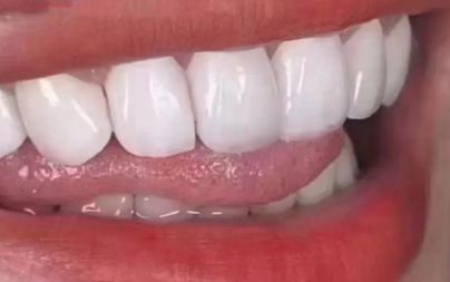 牙贴面能维持终身吗？时间久了是否会损坏？