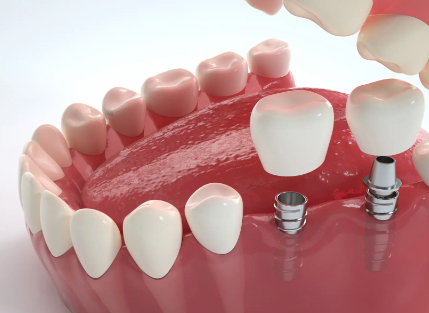 在深圳做种植牙选哪家？十家值得推荐的优质医院