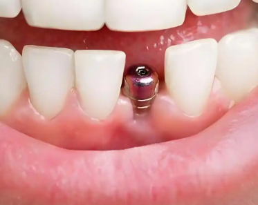 在福州看牙去哪家？福能海峡、美可普口腔种植牙对比解析！