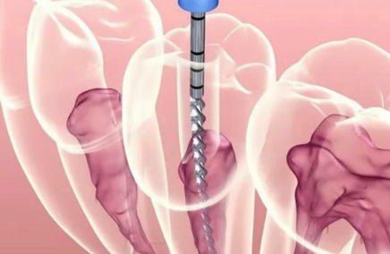 根管治疗后牙疼怎么办？这些原因和缓解方法你需要知道！