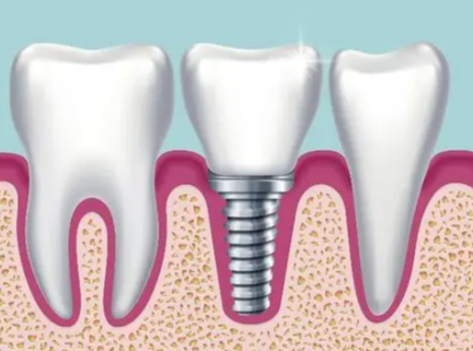 保定种植牙去哪家好？靠谱医院+实惠价格推荐！