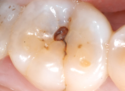 龋齿易发部位大揭秘！为什么这些牙齿更容易蛀牙？