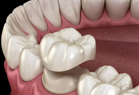 烤瓷牙 vs 全瓷牙：哪种更适合做牙套？详解区别与优缺点