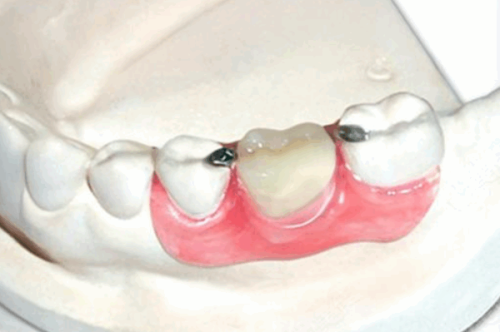 种植牙寿命知多少