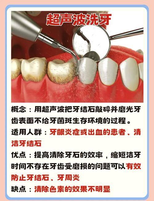 健康人群的洗牙频率