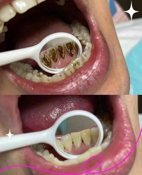 有吸烟、饮茶或咖啡习惯人群的洗牙频率