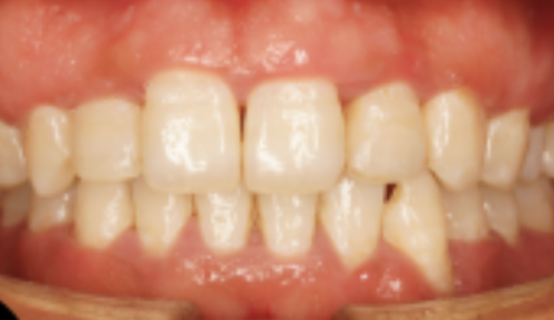 牙齿不齐对咬合功能的影响