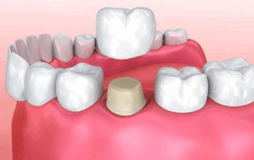 不能做核磁共振的烤瓷牙类型