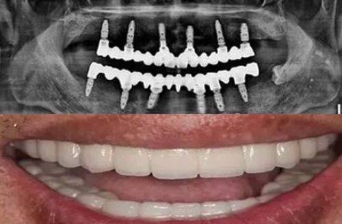 不同牙齿的根管数量及费用范围