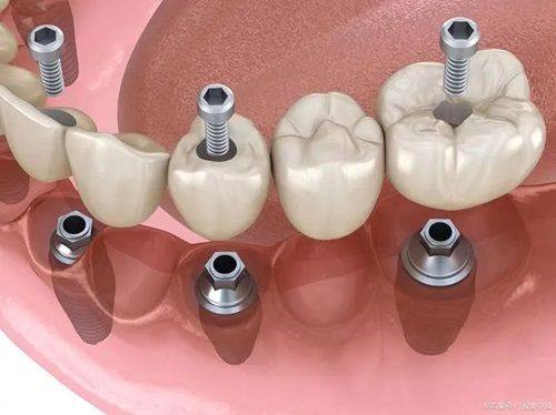 韩国种植牙品牌价格