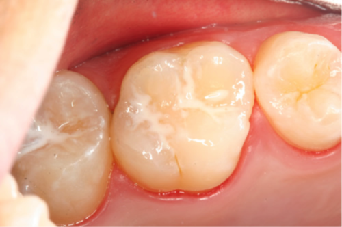 哪些孩子适合做窝沟封闭