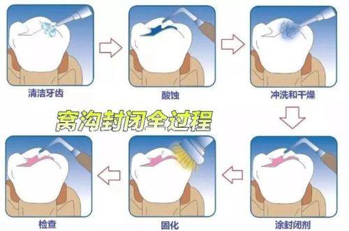 窝沟封闭的过程是怎样的