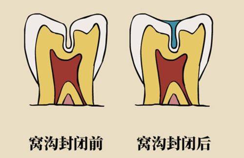 窝沟封闭与其他防龋方法的比较
