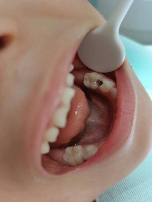 补牙操作质量的重要性