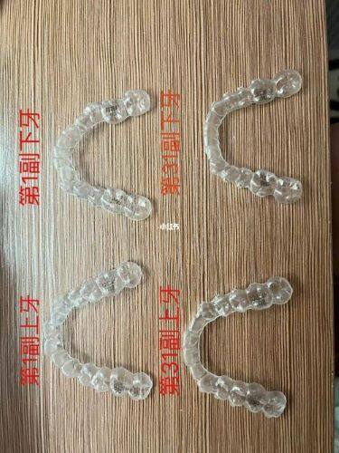 直接补牙材料及费用