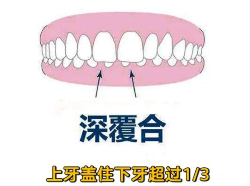 间接补牙费用探秘