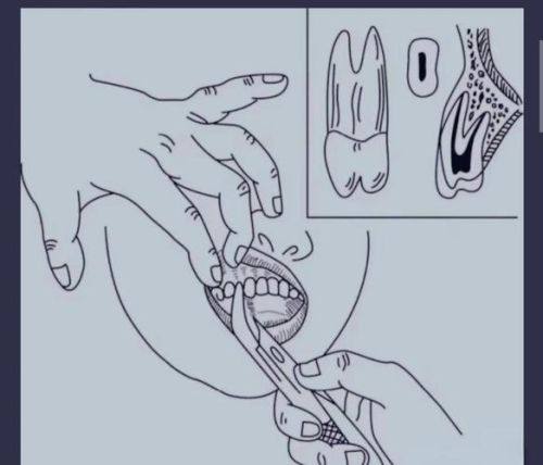 拔牙医疗保险报销的具体流程是怎样的？