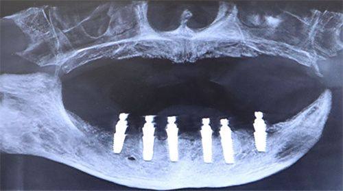 种植牙各阶段所需时间