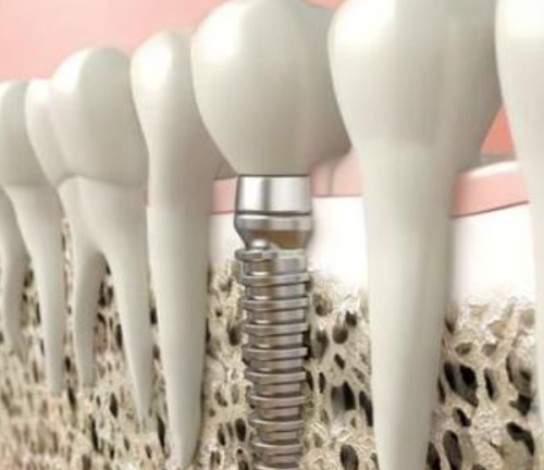 修复咬合与咀嚼功能