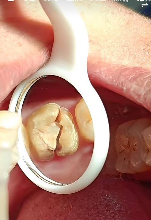 上颌磨牙根管再治疗