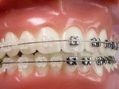 陶瓷托槽：美观与挑战并存