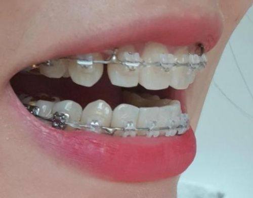 矫正成效：材质并非关键