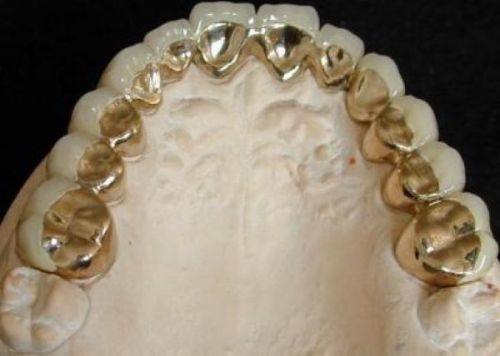 揭秘烤瓷牙种类：7种选择让你的微笑更自信！