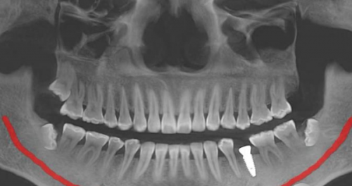 揭秘种植牙护理技巧，延长使用寿命