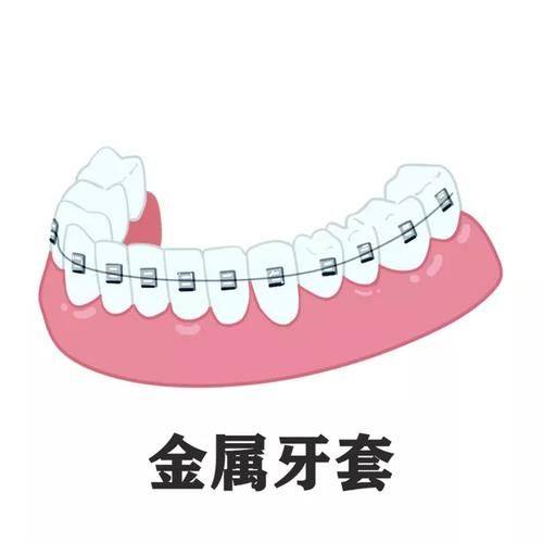 佩戴金属牙套的好处
