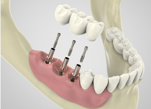 不同医院的种植牙报价对比