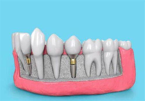 恒信齿科：数字化种植的先锋