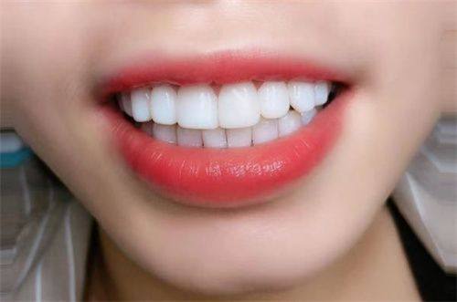 如何选择适合自己的牙齿美白方法