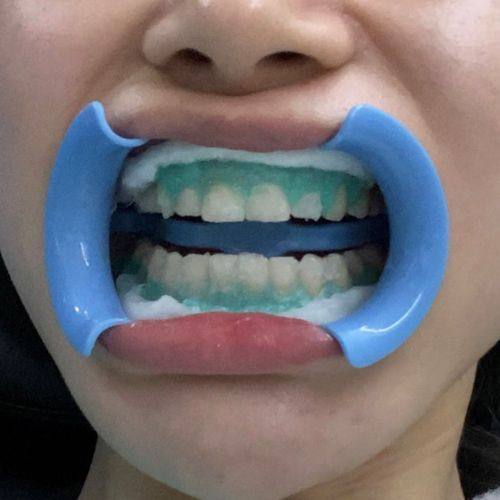 日常口腔护理对维持时间的影响