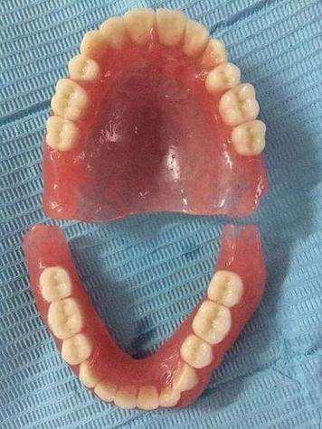 植体植入后制作固定桥的时间