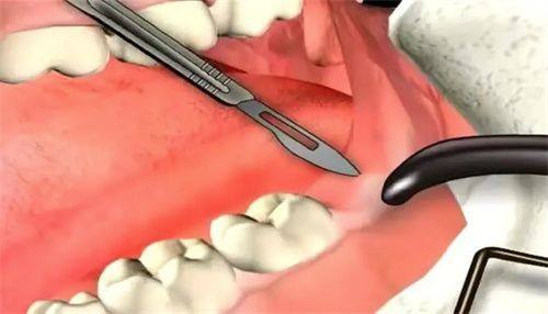 复杂拔牙：三天左右的攻坚战