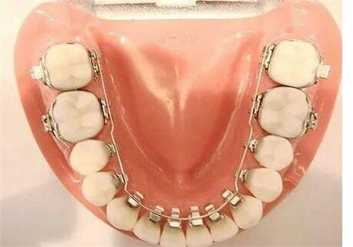 特殊正畸方法的费用