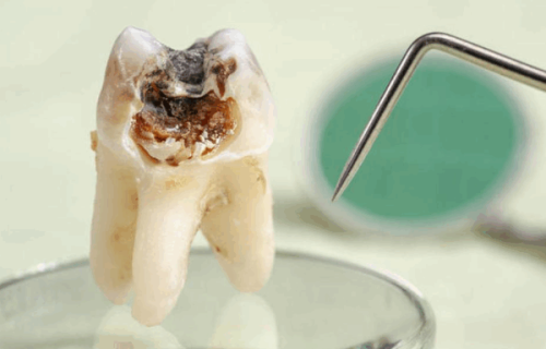 定期复诊，及时处理龋齿问题