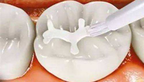 补牙后内部会继续烂的原因