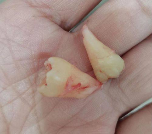 影响拔牙拆线疼痛程度的因素