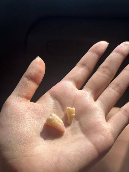 缓解拔牙拆线疼痛的方法