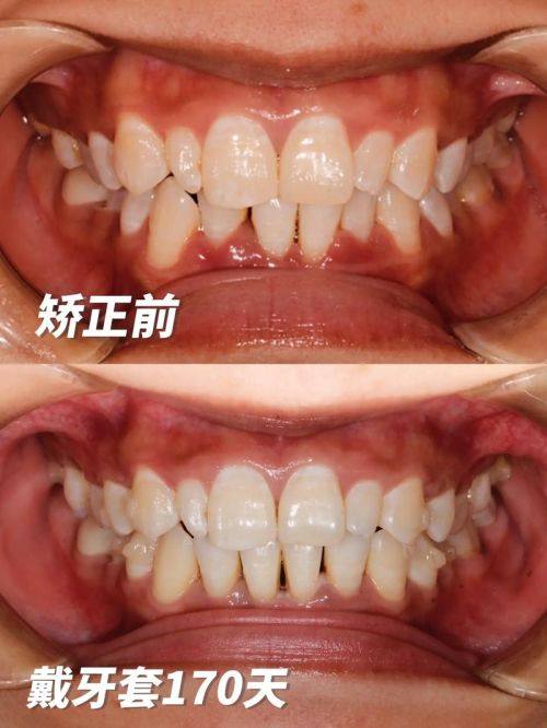 牙齿矫正隐形矫正多少钱？2025年价格揭秘！
