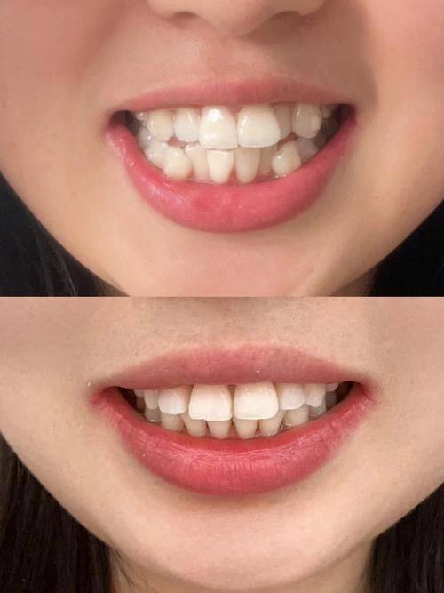 影响隐形矫正价格的因素